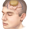 Apa itu meningioma otak? Adakah kanser?