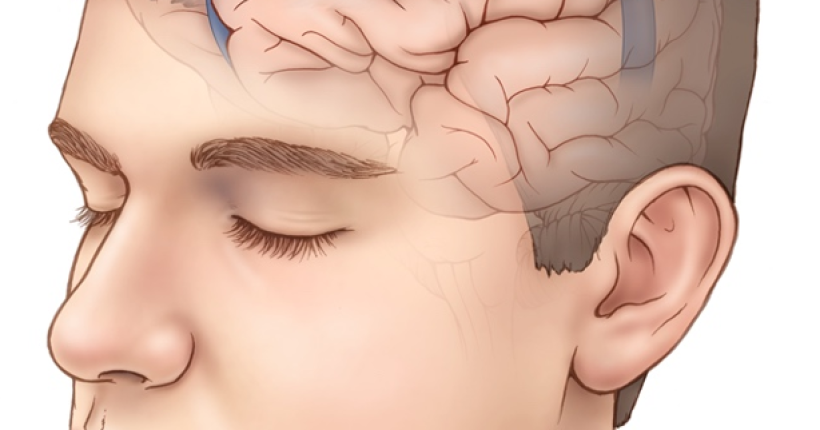 meningiomas-gambaran - persoalan my