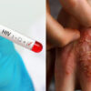 Apakah Ciri-Ciri seseorang itu menghidap HIV