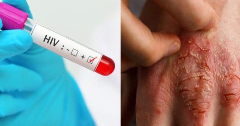 Apakah Ciri-Ciri seseorang itu menghidap HIV